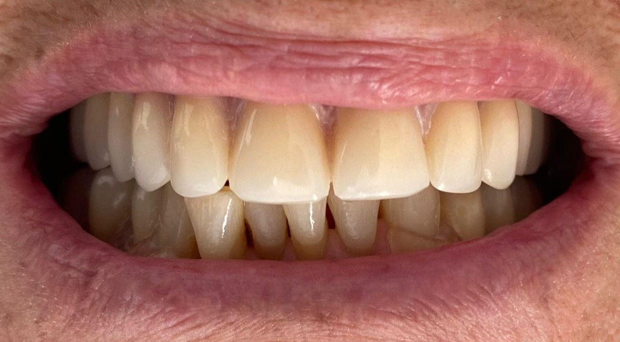 Prótesis removible — foto 4